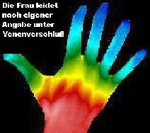 Hand mit Venenverschluss